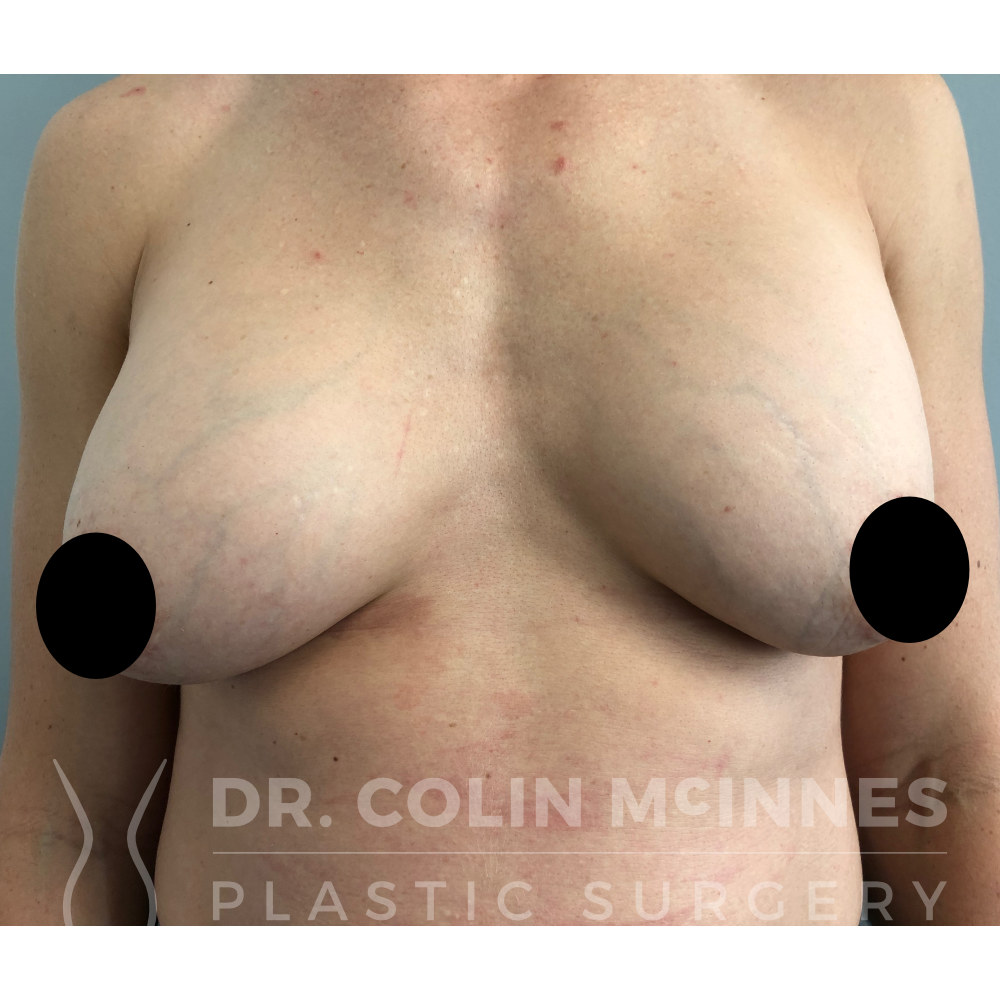 Explant with Immediate Breast Lift - BEFORE