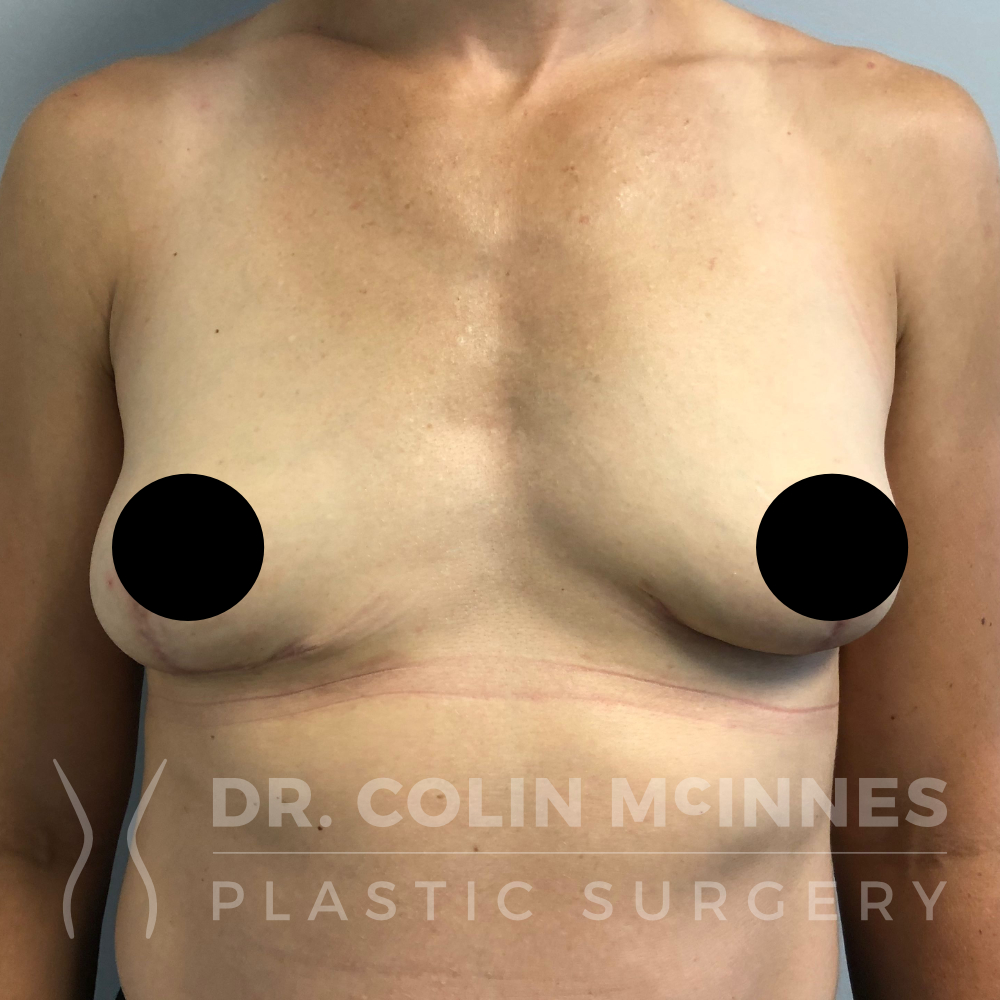 Explant with Immediate Breast Lift - 3 MONTHS POST OP