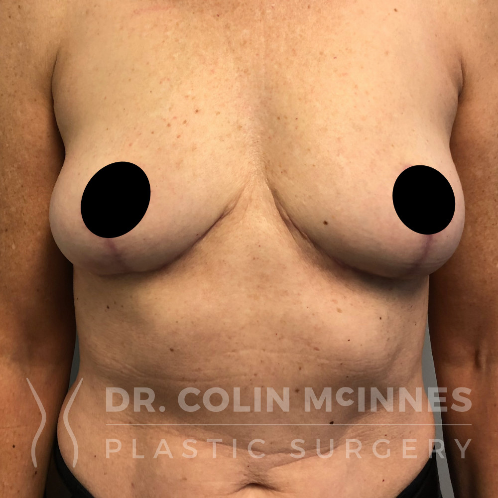 Implant Removal / Capsulectomy & Immediate Lift - 6 MONTHS POST-OP