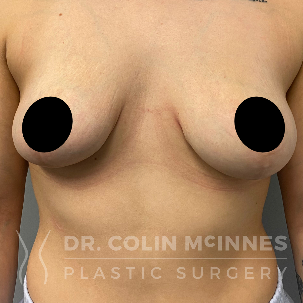Breast Lift - AFTER