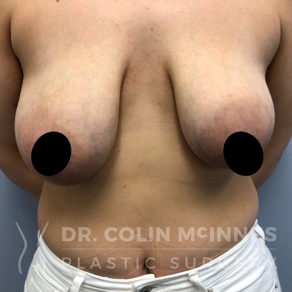 Breast Lift - BEFORE