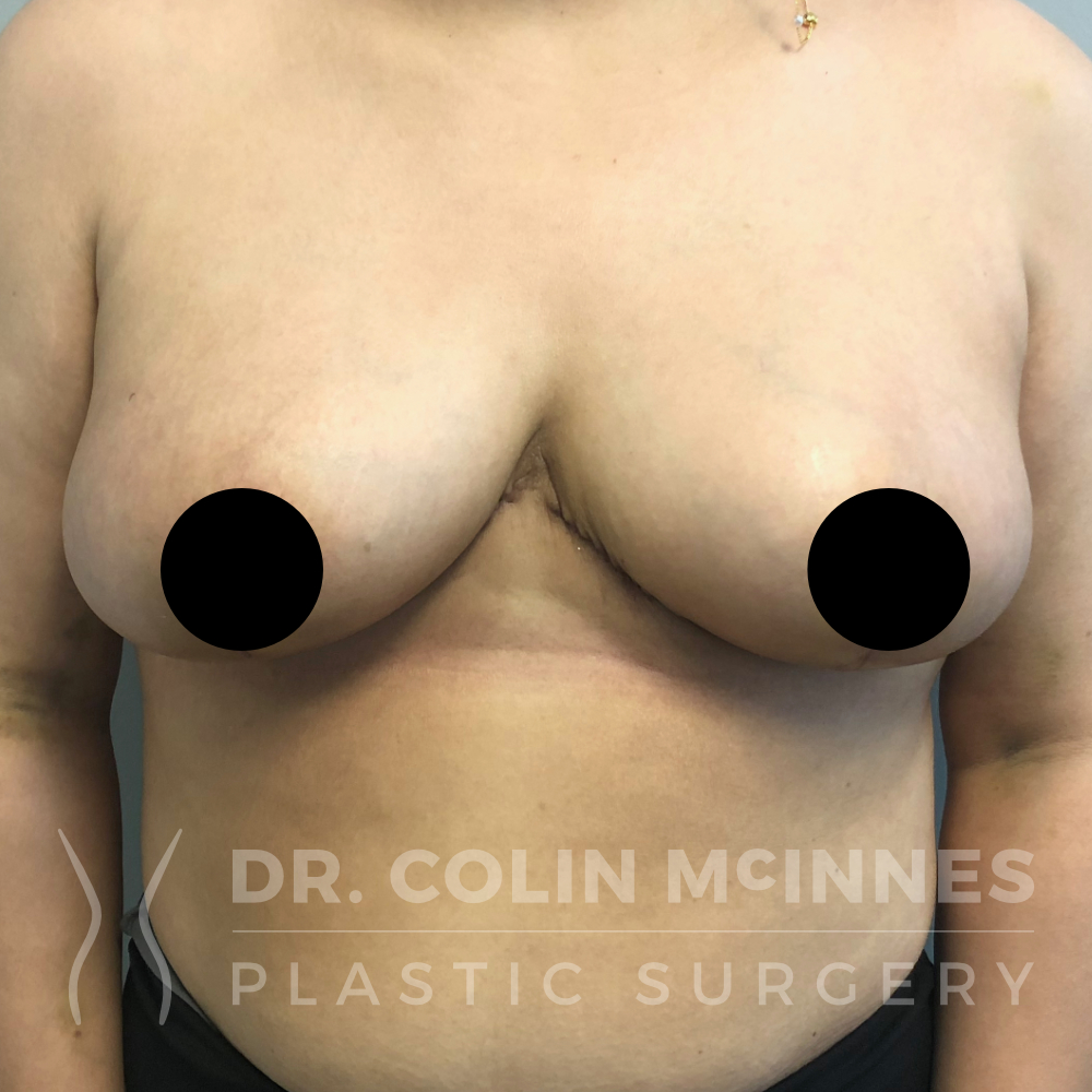 Breast Reduction & Lift - EARLY POST OP