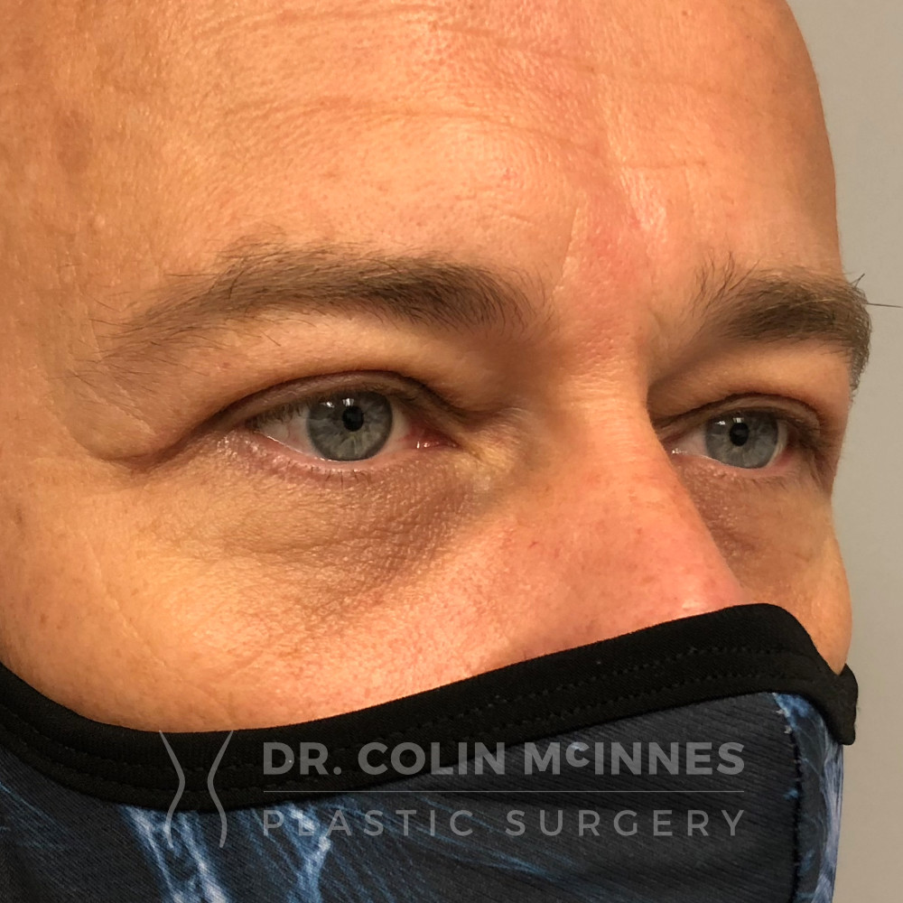 Upper Lid Blepharoplasty - 4 WEEKS POST-OP