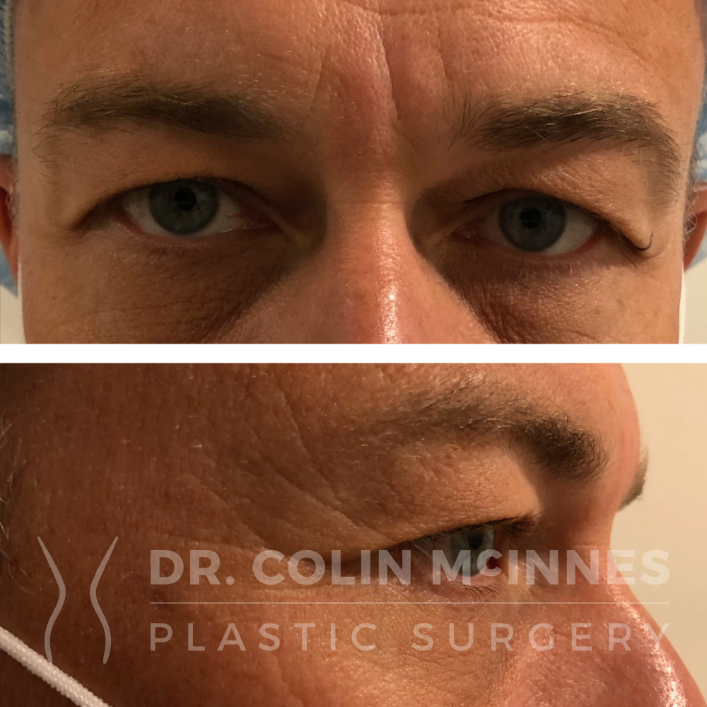 Upper Lid Blepharoplasty - BEFORE