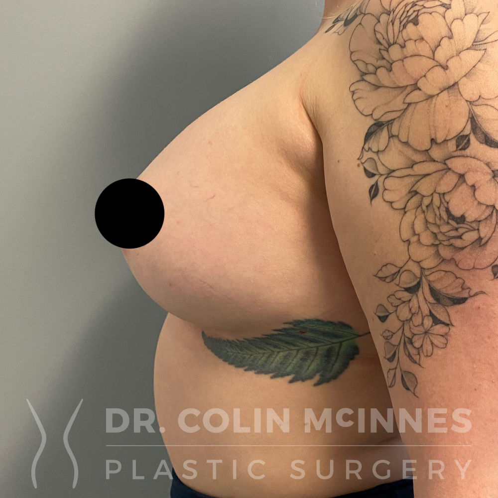Bilateral Breast Augmentation with Internal Bra Support - 3 MONTHS POST OP