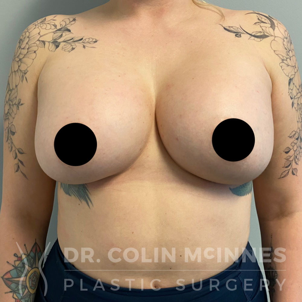 Bilateral Breast Augmentation with Internal Bra Support - 3 MONTHS POST OP