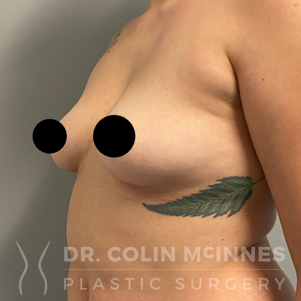 Bilateral Breast Augmentation with Internal Bra Support - BEFORE