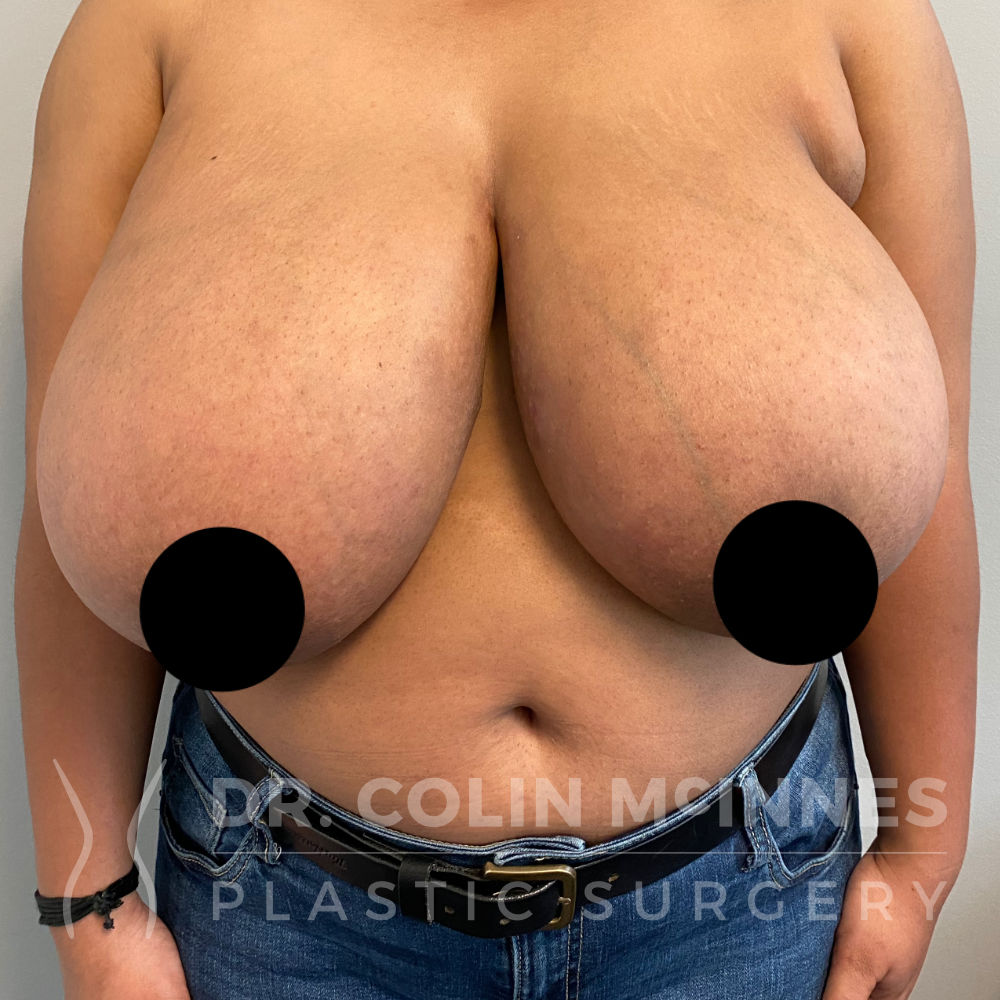 Bilateral Breast Reduction - BEFORE