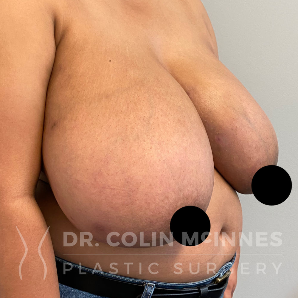 Bilateral Breast Reduction - BEFORE