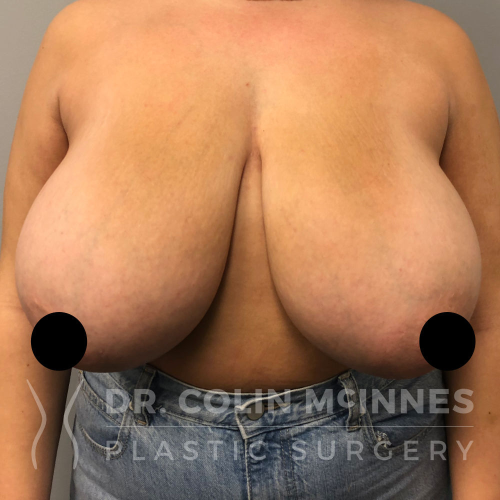 Bilateral Breast Reduction - BEFORE