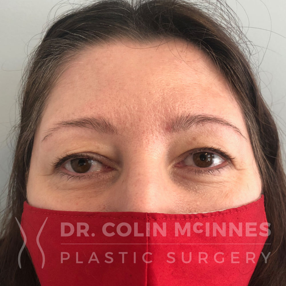 Upper Eyelid Blepharoplasty - BEFORE