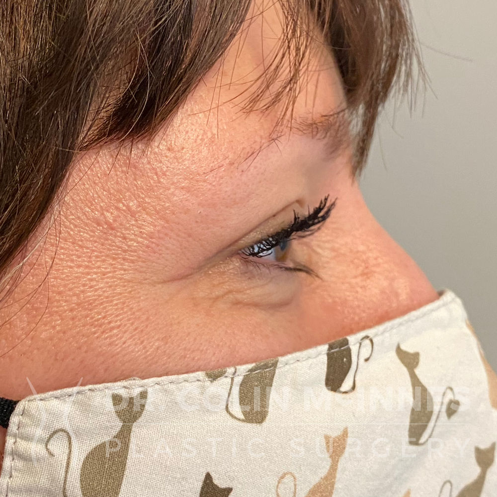 Upper Eyelid Blepharoplasty - AFTER