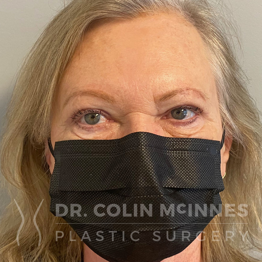 Upper Blepharoplasty, mole removal + forehead Botox - AFTER