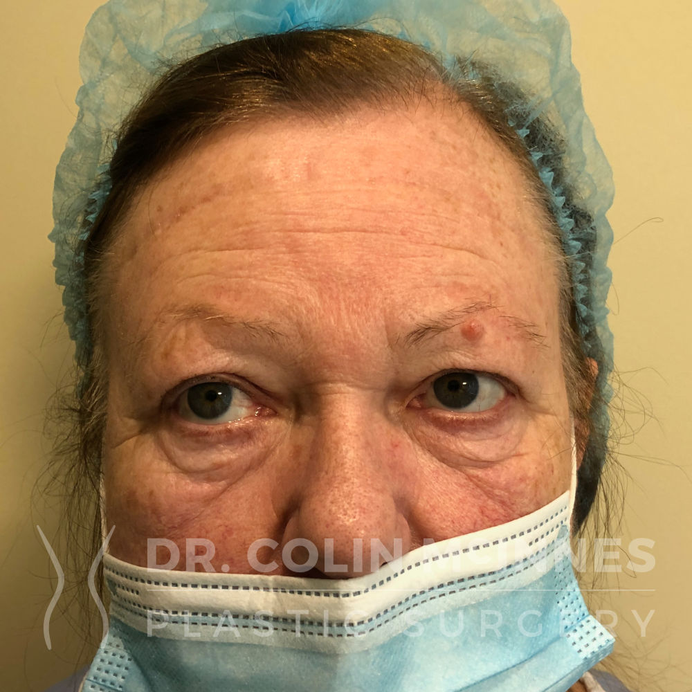 Upper Blepharoplasty, mole removal + forehead Botox - BEFORE Upper Blepharoplasty, mole removal + forehead Botox - BEFORE