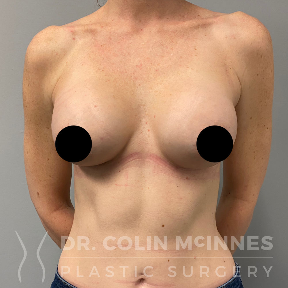 Breast Augmentation - AFTER
