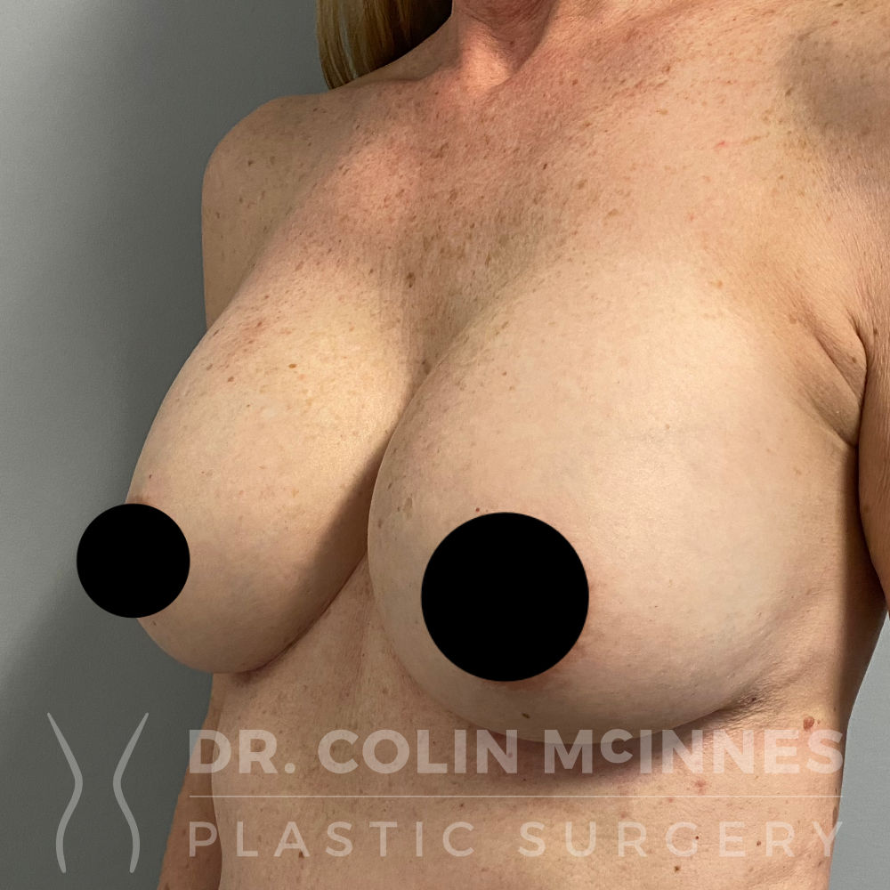 Breast Augmentation w/internal bra support - AFTER