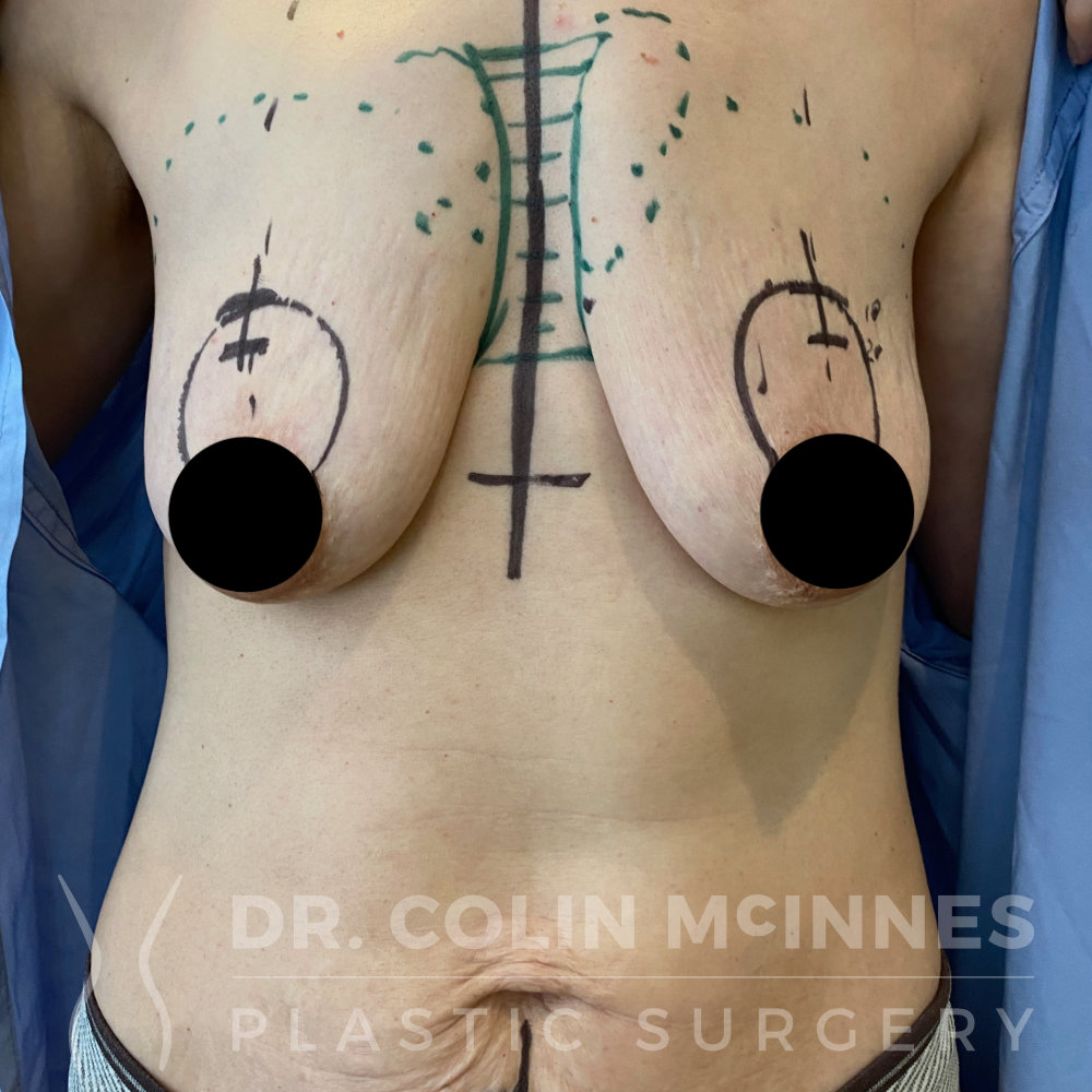 Breast Augmentation Mastopexy + Fat Grafting - BEFORE (WITH SURGICAL MARKINGS)