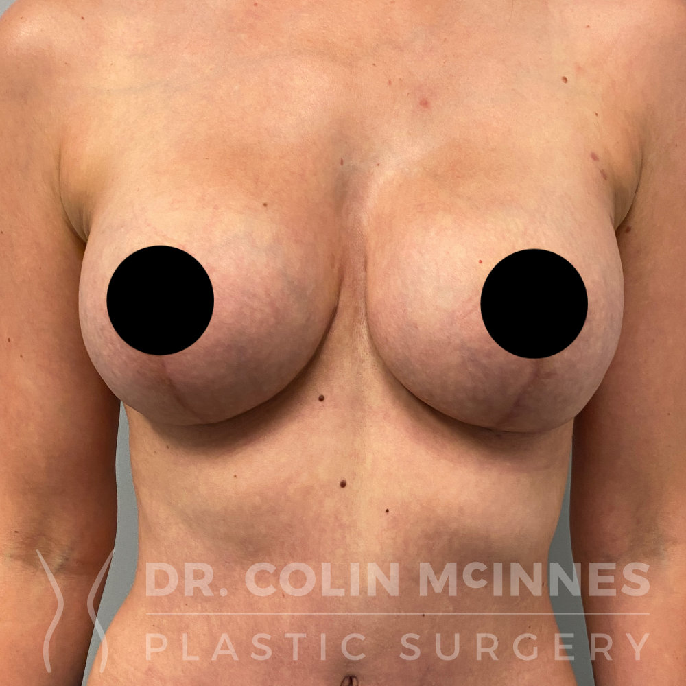 Breast Augmentation with New Implants - 7 WEEKS AFTER