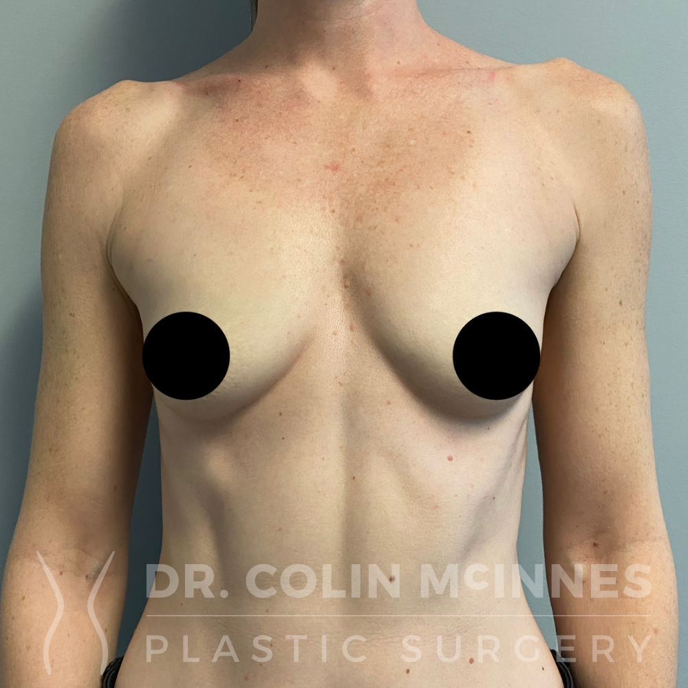 Breast Augmentation - BEFORE