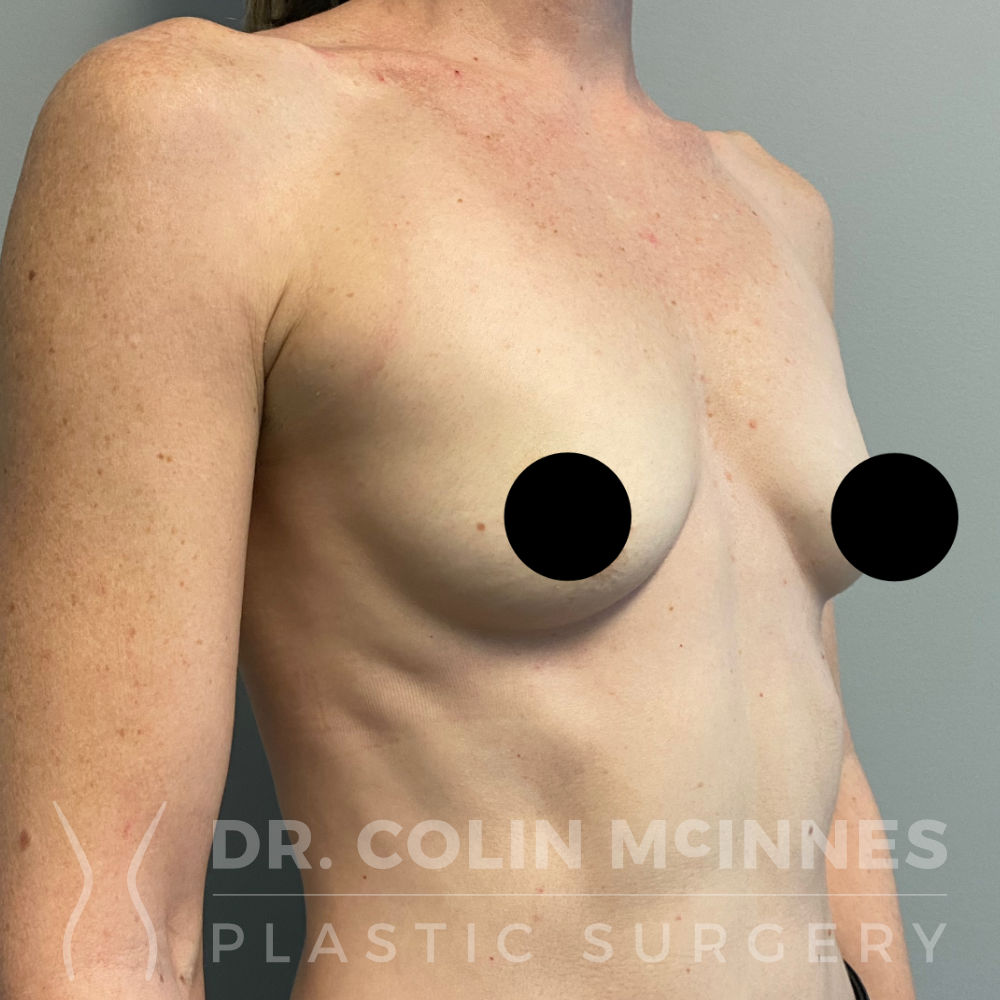 Breast Augmentation - BEFORE