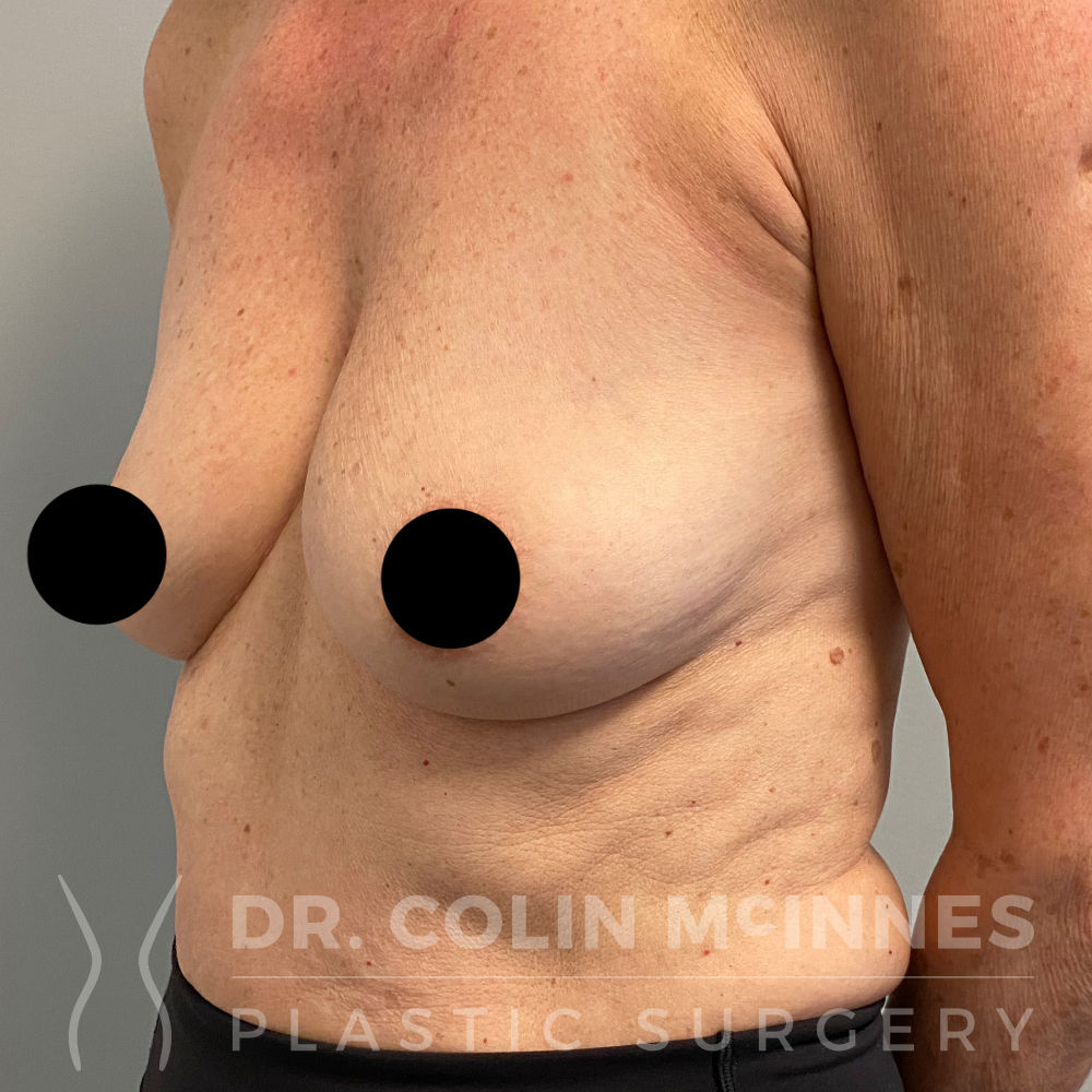 Breast Augmentation w/internal bra support - BEFORE