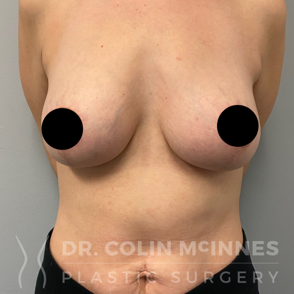 Breast Augmentation Mastopexy + Fat Grafting - AFTER (9 MONTHS)