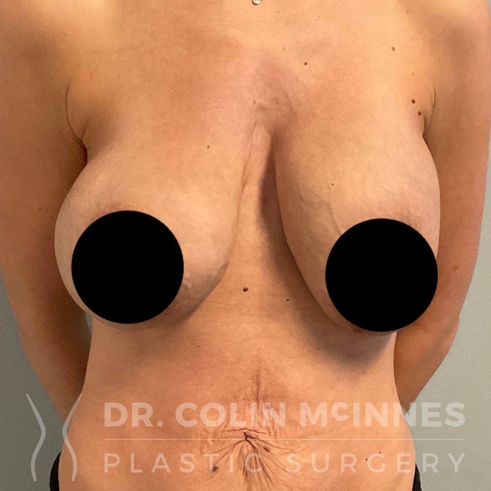 Breast Augmentation with New Implants - BEFORE