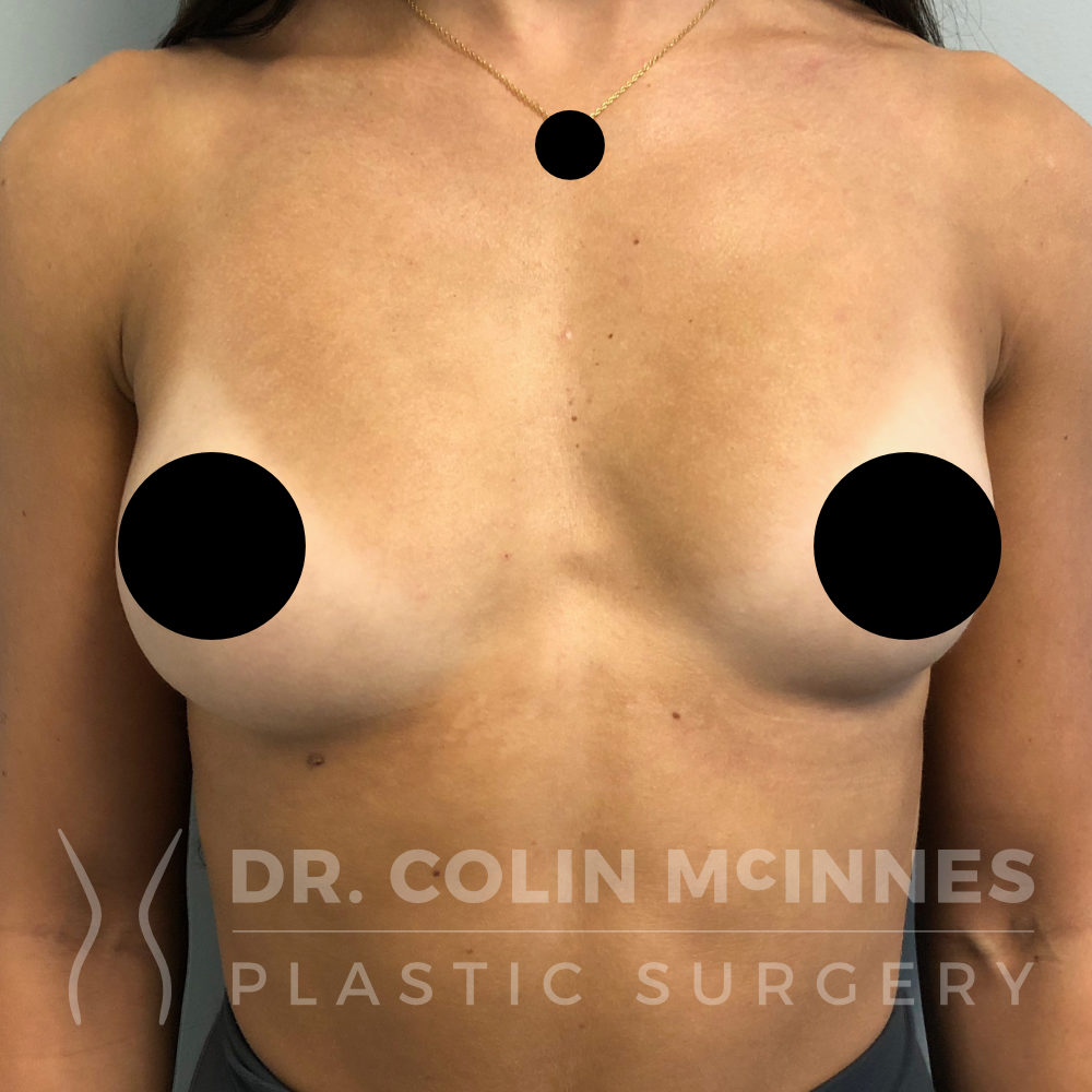 Primary Breast Augmentation - BEFORE