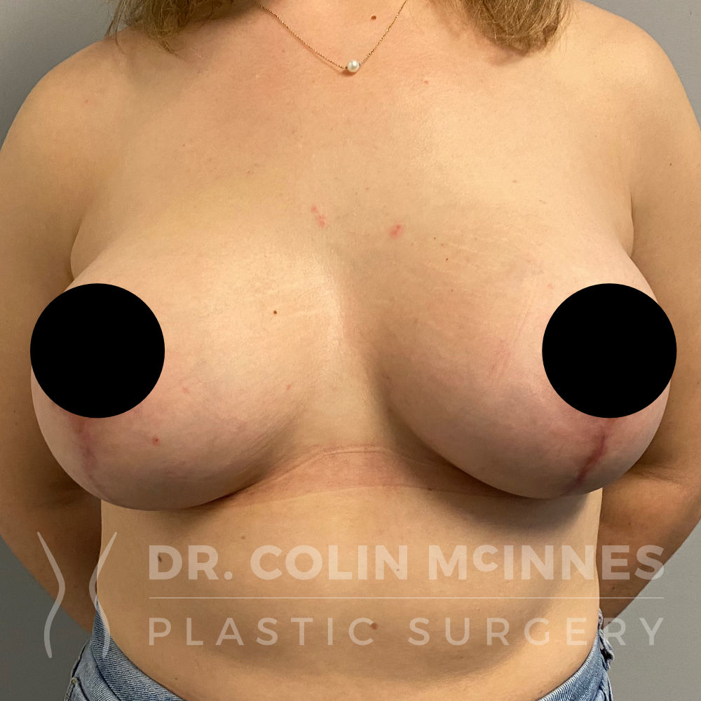 Breast Augmentation Mastopexy - 3 MONTHS