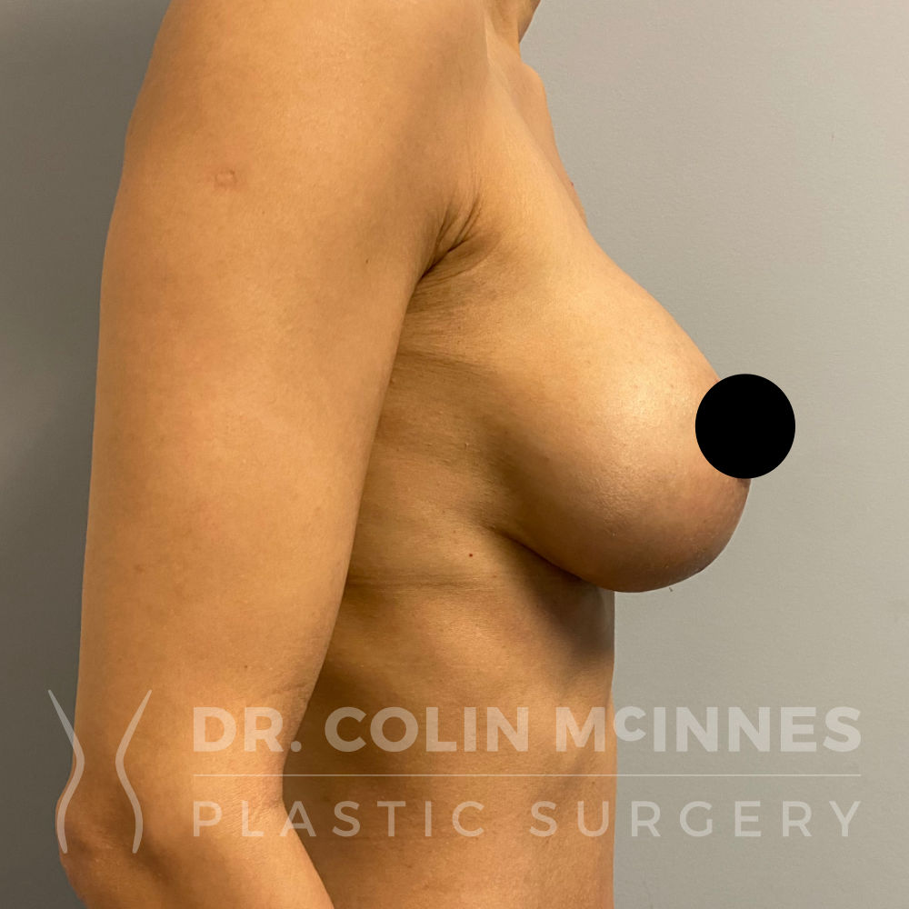 Breast Augmentation Mastopexy - AFTER