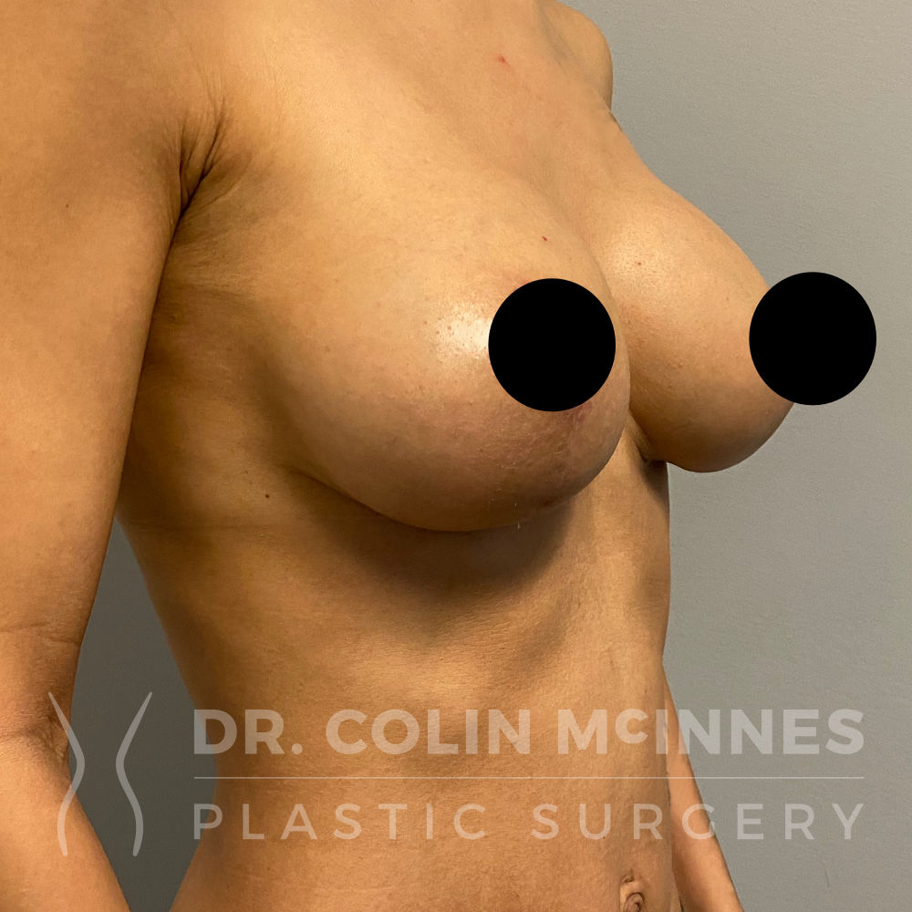 Breast Augmentation Mastopexy - AFTER