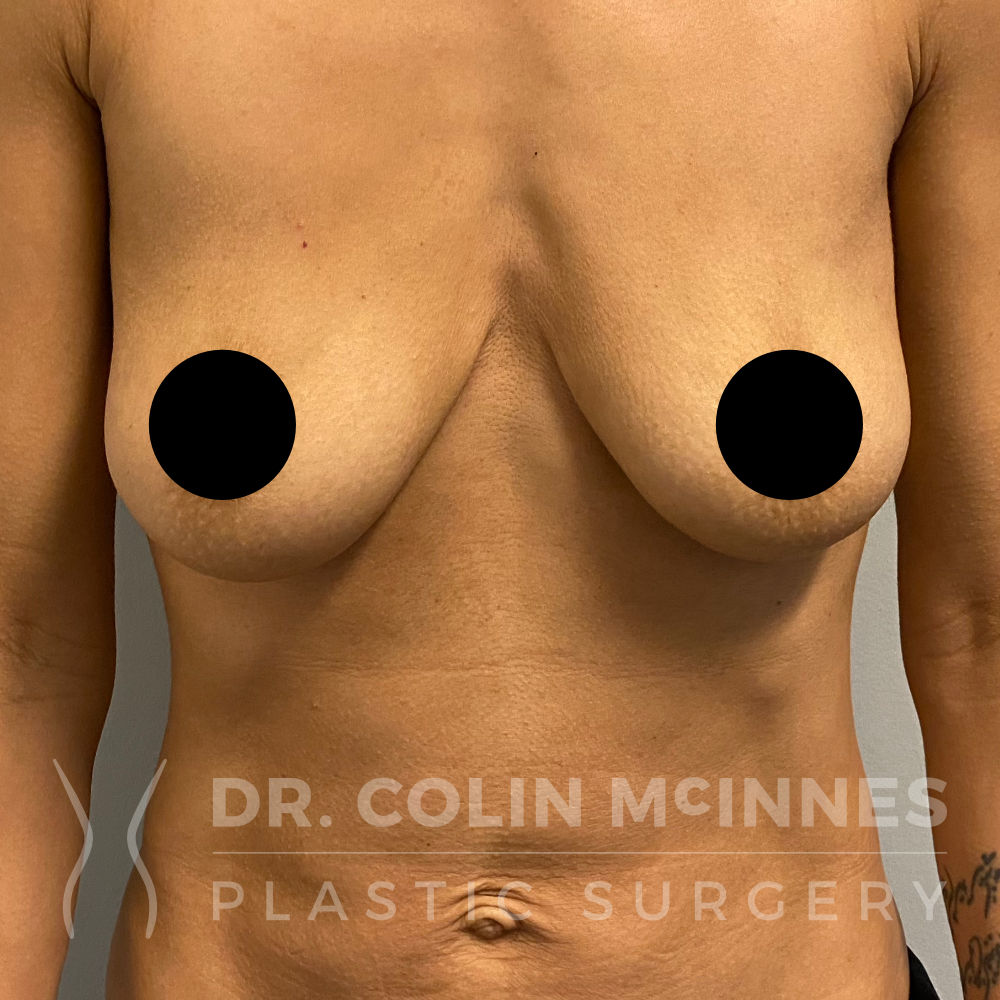 Breast Augmentation Mastopexy - BEFORE
