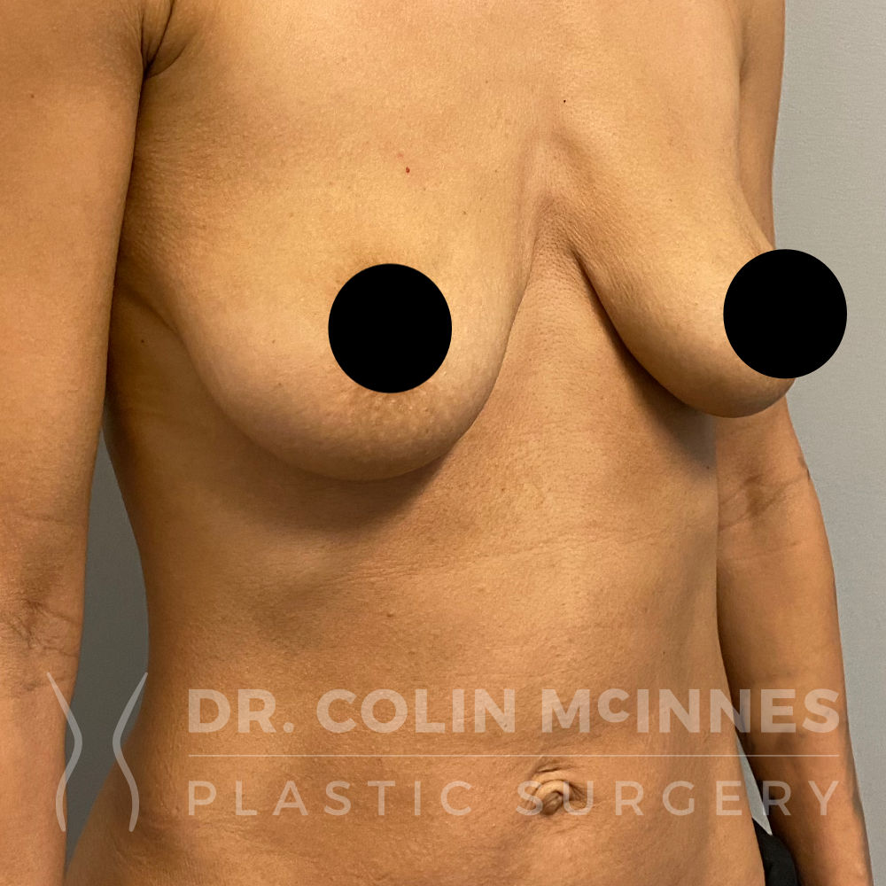 Breast Augmentation Mastopexy - BEFORE