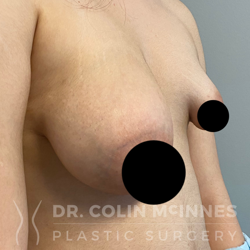 Severe Left Tuberous Breast Deformity - BEFORE