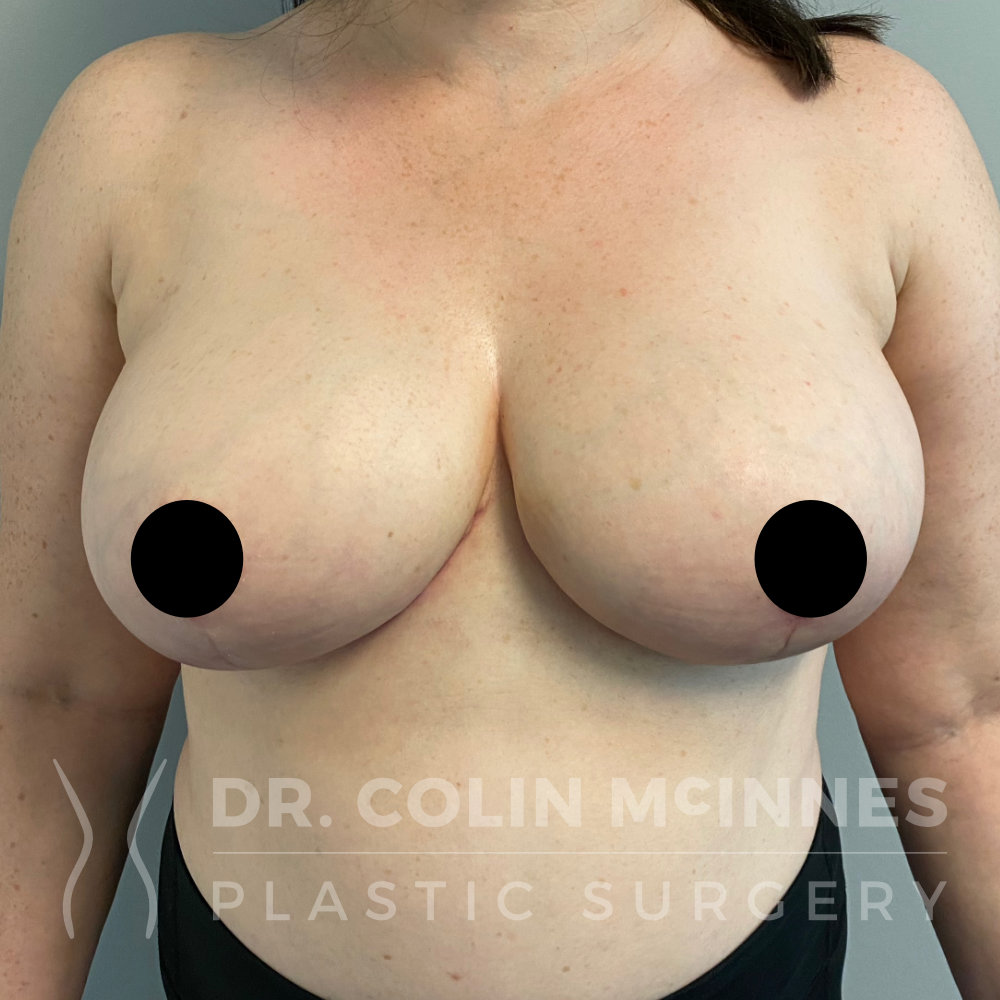 Bilateral Breast Reduction + Underarm Liposuction - 4 WEEKS POST OP