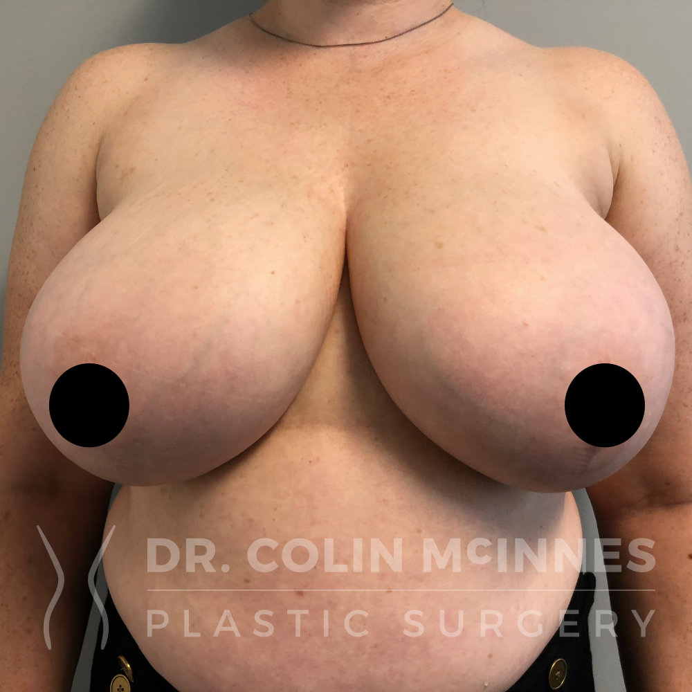 Bilateral Breast Reduction + Underarm Liposuction - BEFORE