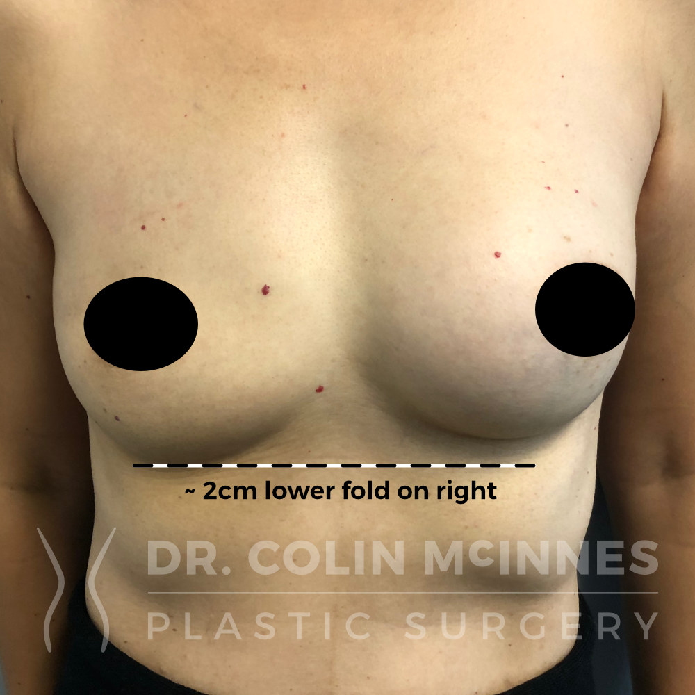 Revision Breast Augmentation - BEFORE