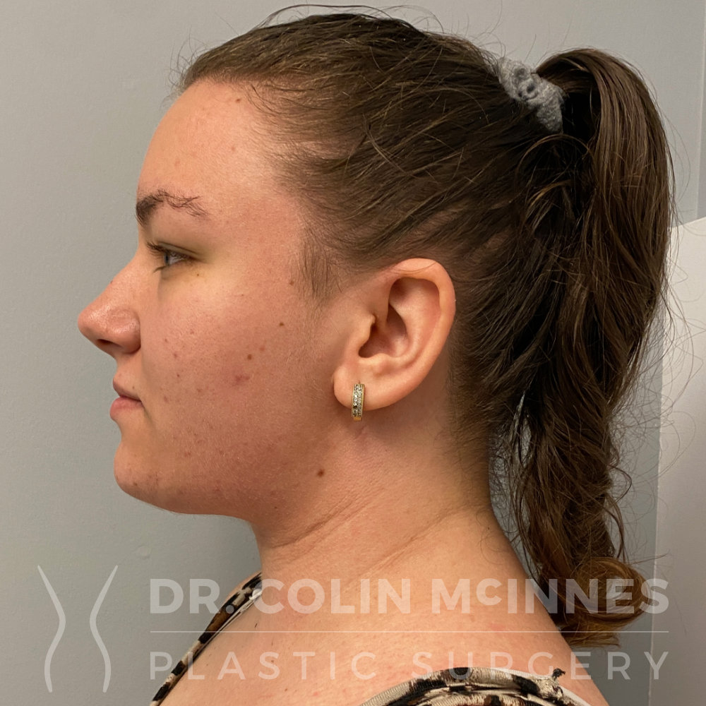 Add Definition To Your Jawline And Chin with Deep Neck Contouring - Utah  Facial Plastics