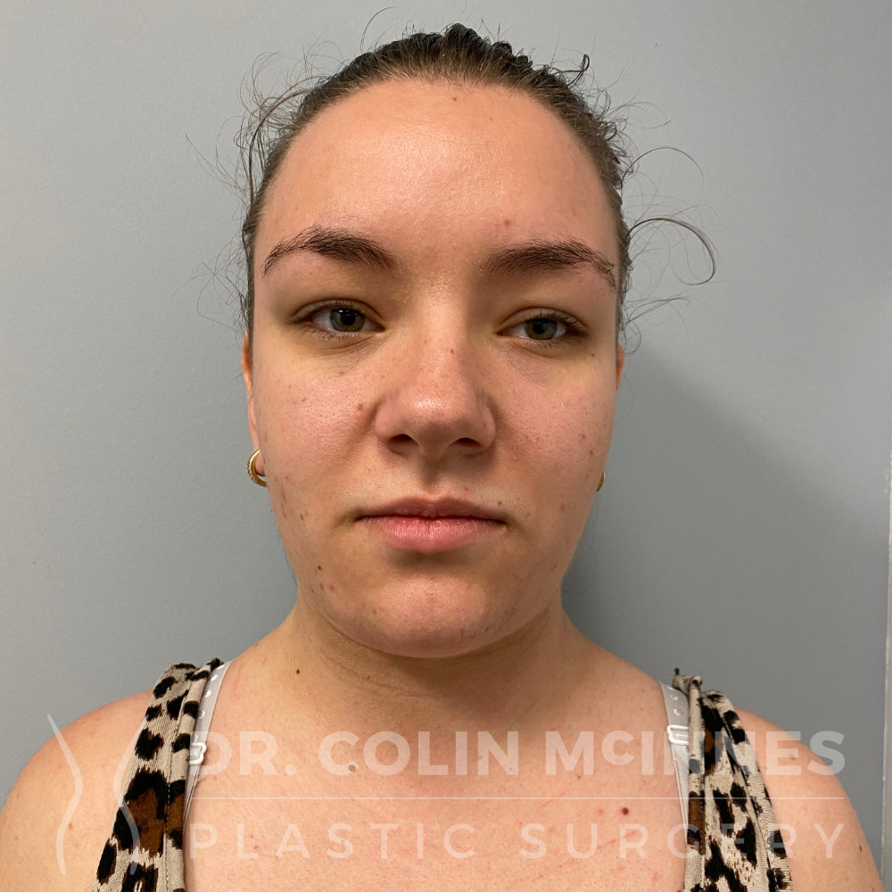 Deep Neck Contouring - 6 MONTHS AFTER