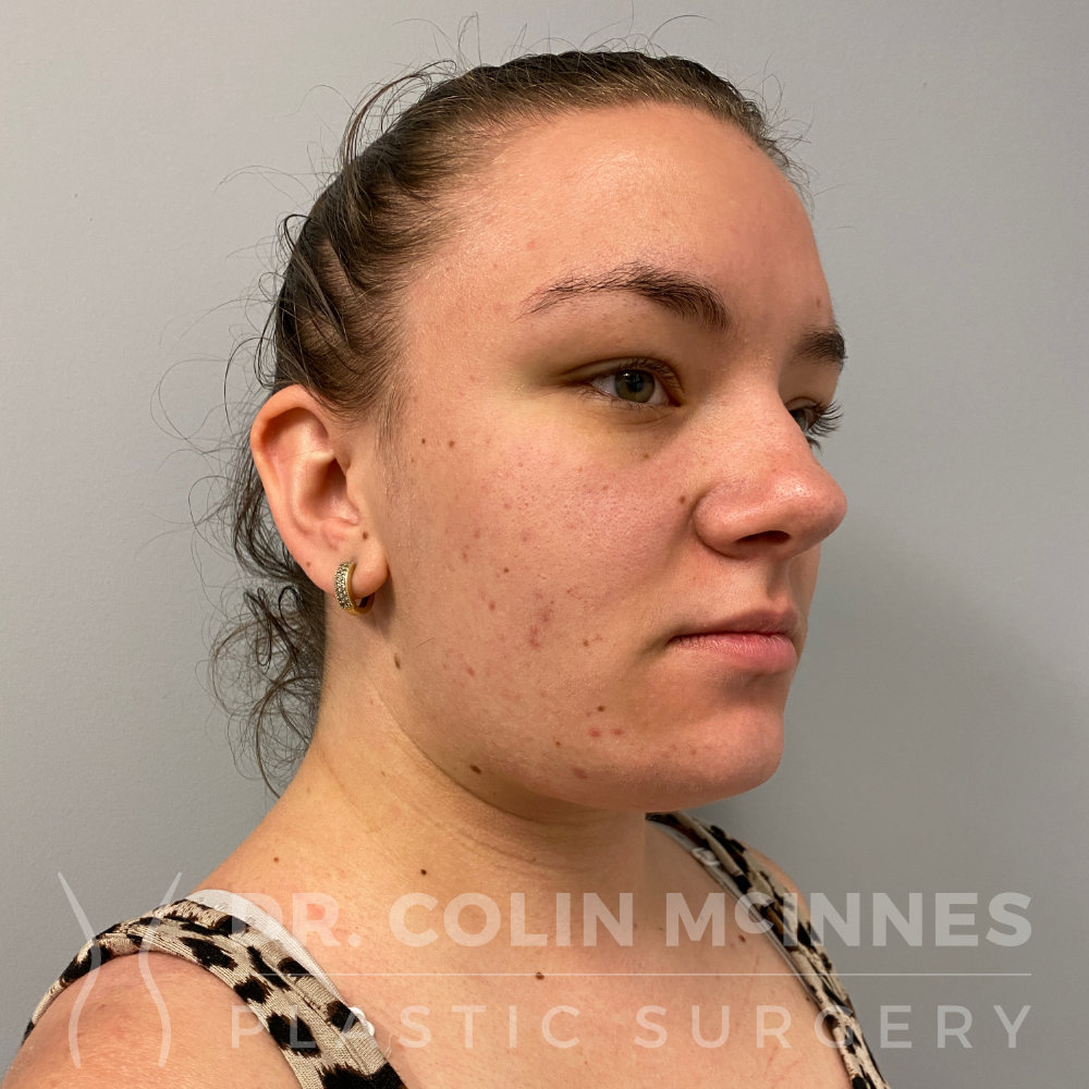 Deep Neck Contouring - 6 MONTHS AFTER