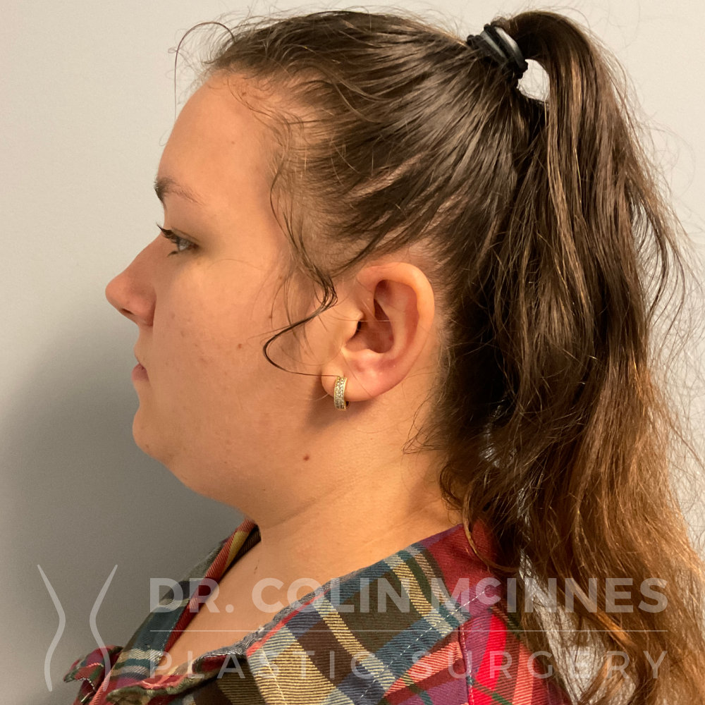 Deep Neck Contouring - BEFORE