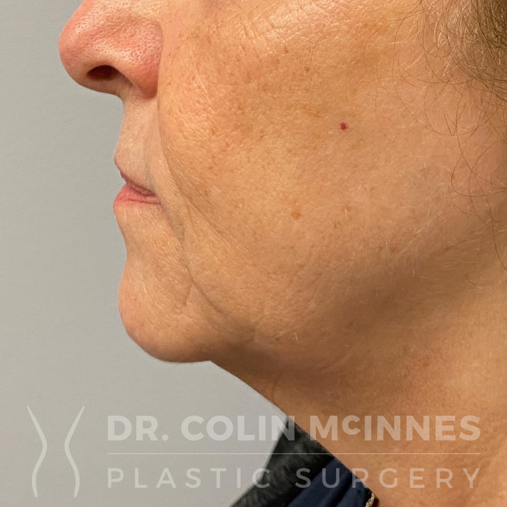 Extended Deep-Plane Face & Neck Lift - BEFORE