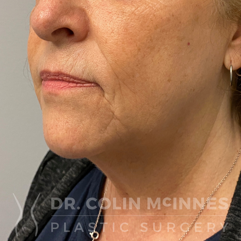 Extended Deep-Plane Face & Neck Lift - BEFORE