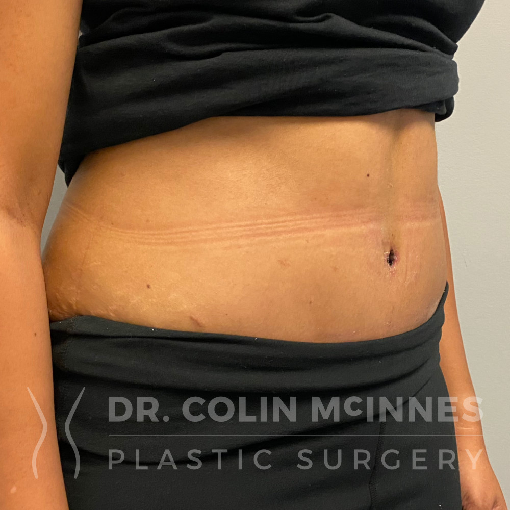 Drainless Abdominoplasty with Liposuction - 2 WEEKS POST-OP