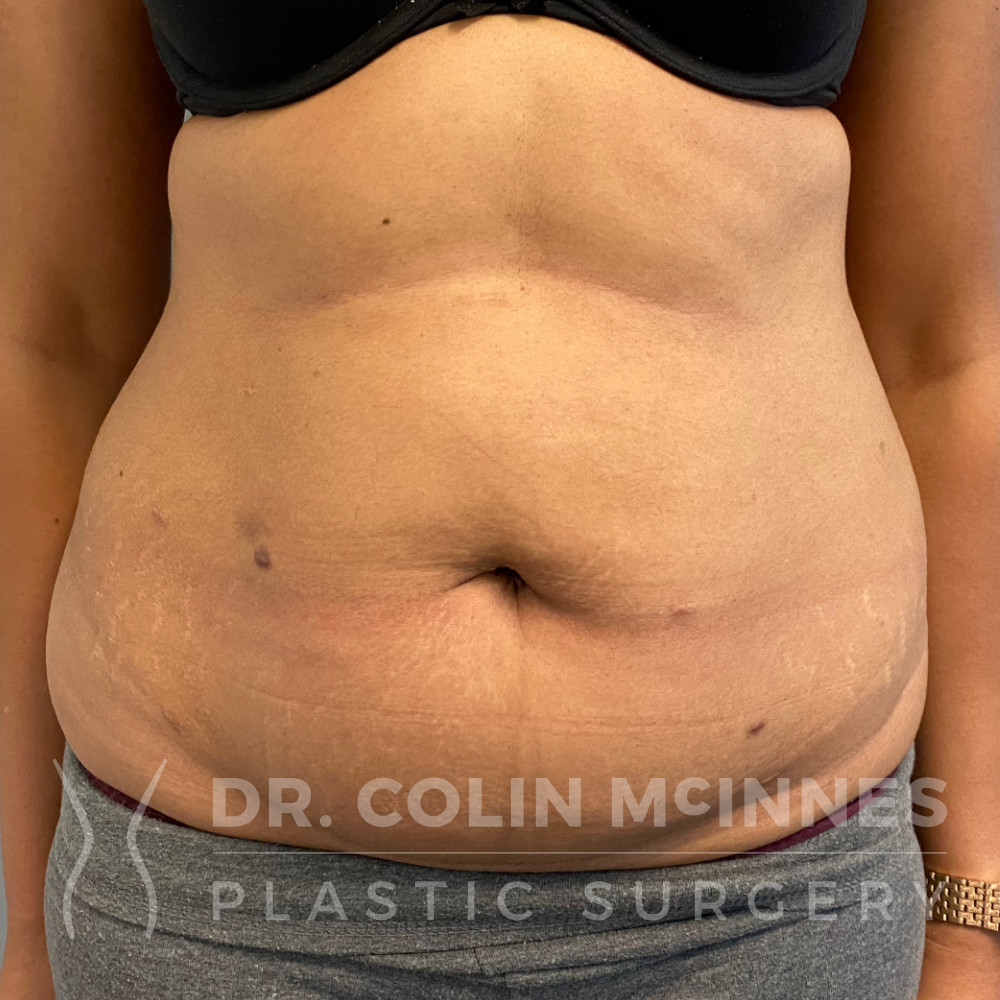 Drainless Abdominoplasty with Liposuction - BEFORE