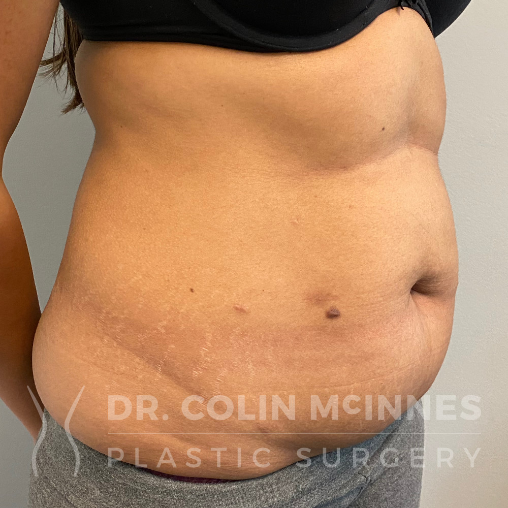 Drainless Abdominoplasty with Liposuction - BEFORE