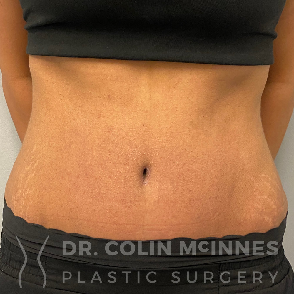 Drainless HD Tummy Tuck - 6 WEEKS AFTER