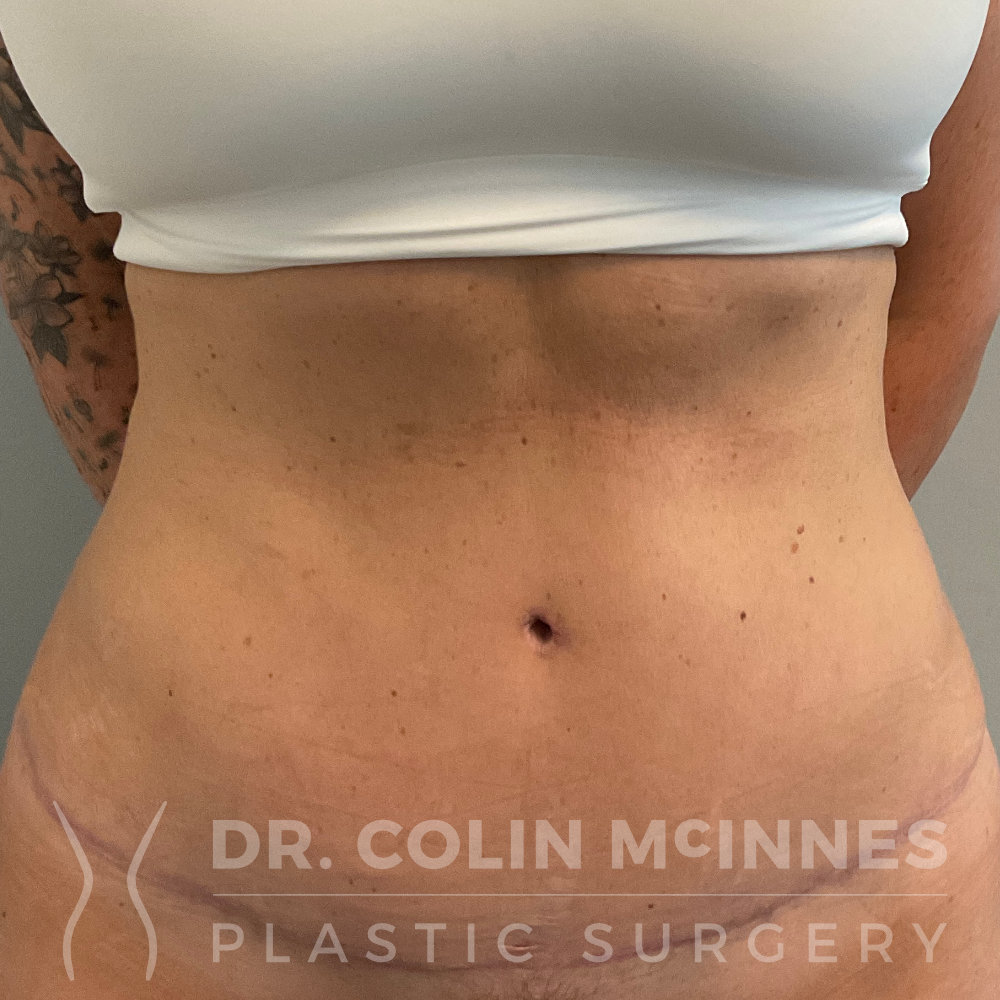 Drainless HD Tummy Tuck - 5 MONTHS AFTER