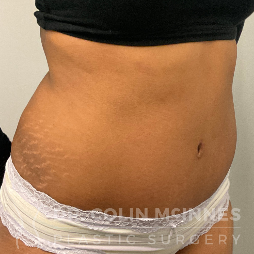 Drainless HD Tummy Tuck - 2.5 MONTHS AFTER