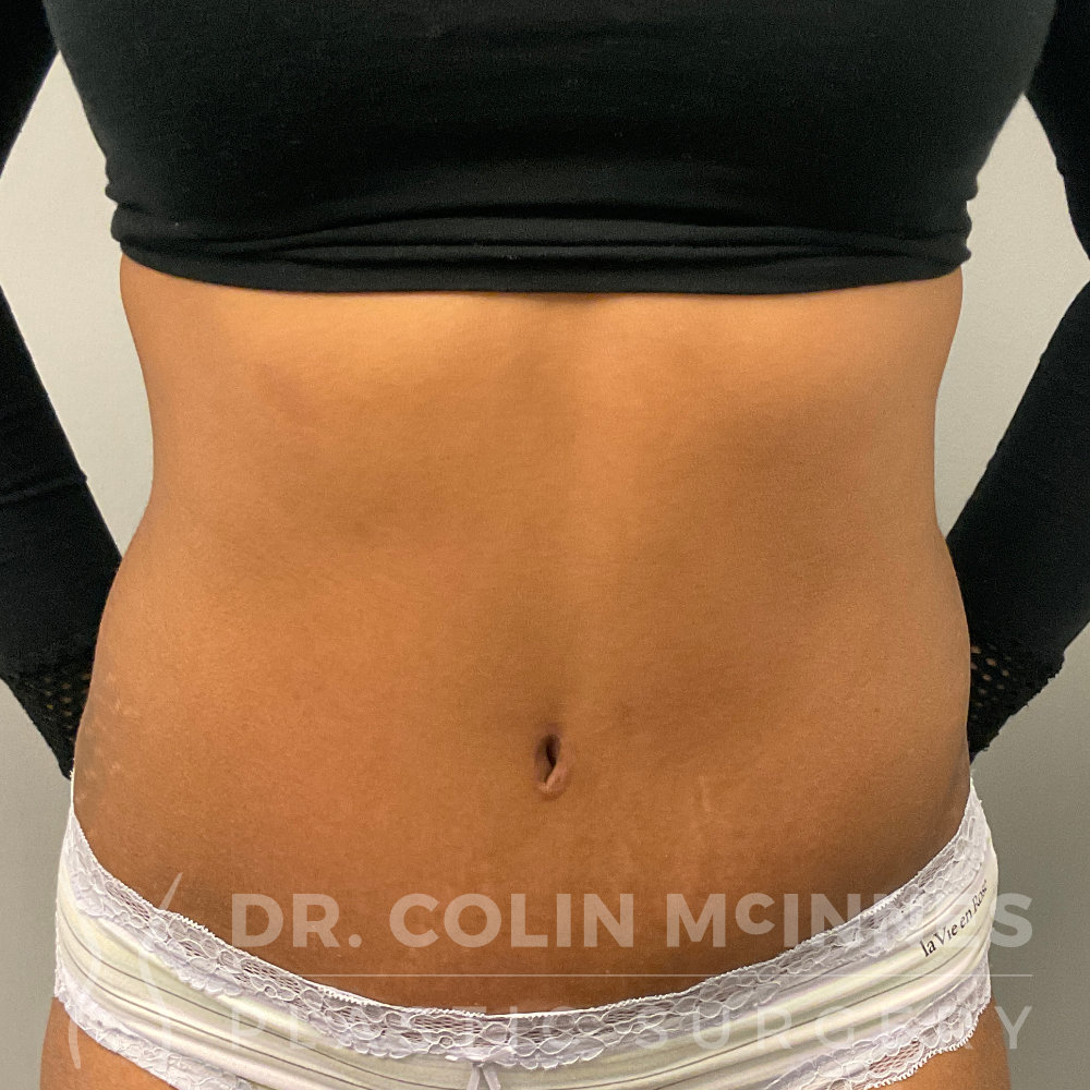 Drainless HD Tummy Tuck - 2.5 MONTHS AFTER